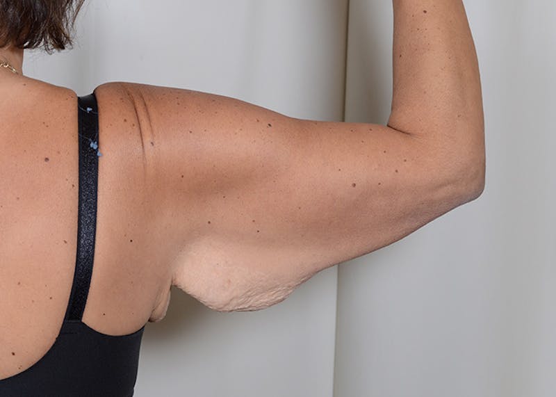 Arm Lift Before & After Gallery - Patient 384286 - Image 1