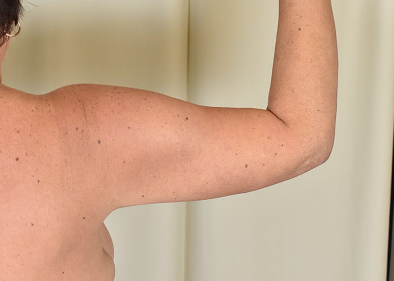 Arm Lift Before & After Gallery - Patient 384286 - Image 2