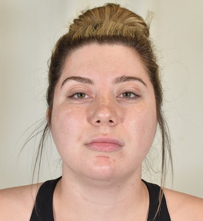 Liposuction Before & After Gallery - Patient 167433 - Image 1
