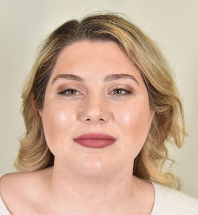 Liposuction Before & After Gallery - Patient 167433 - Image 2