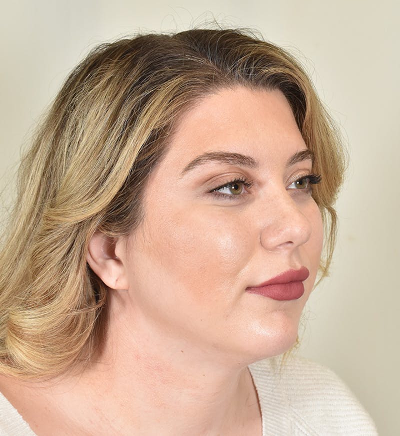 Liposuction Before & After Gallery - Patient 167433 - Image 4