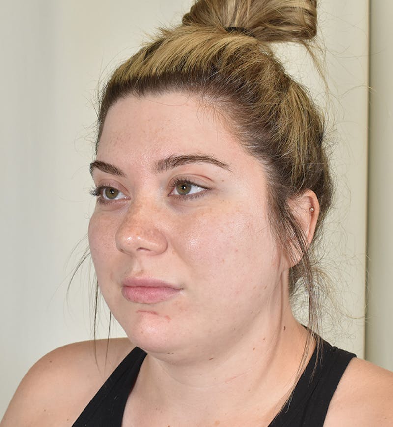 Liposuction Before & After Gallery - Patient 167433 - Image 7