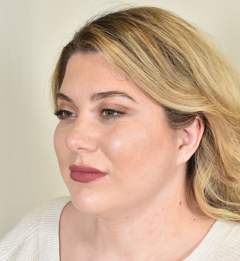 Liposuction Before & After Gallery - Patient 167433 - Image 8