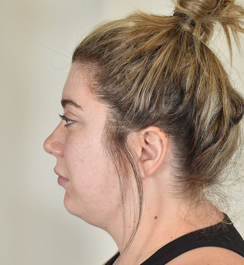 Liposuction Before & After Gallery - Patient 167433 - Image 9