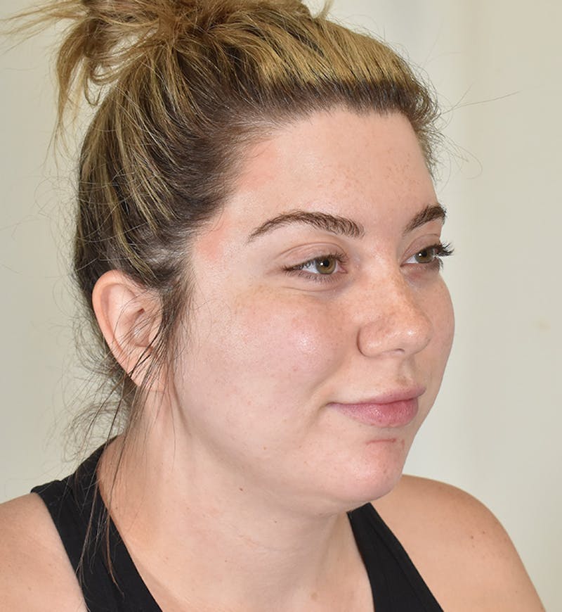 Liposuction Before & After Gallery - Patient 167433 - Image 3