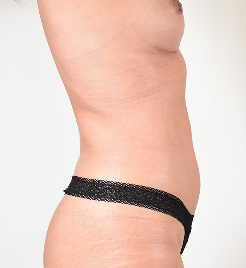 Liposuction Before & After Gallery - Patient 167859 - Image 4
