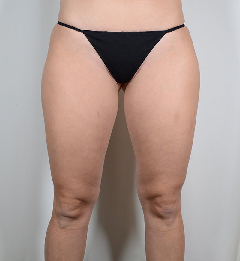 Liposuction Before & After Gallery - Patient 608050 - Image 13