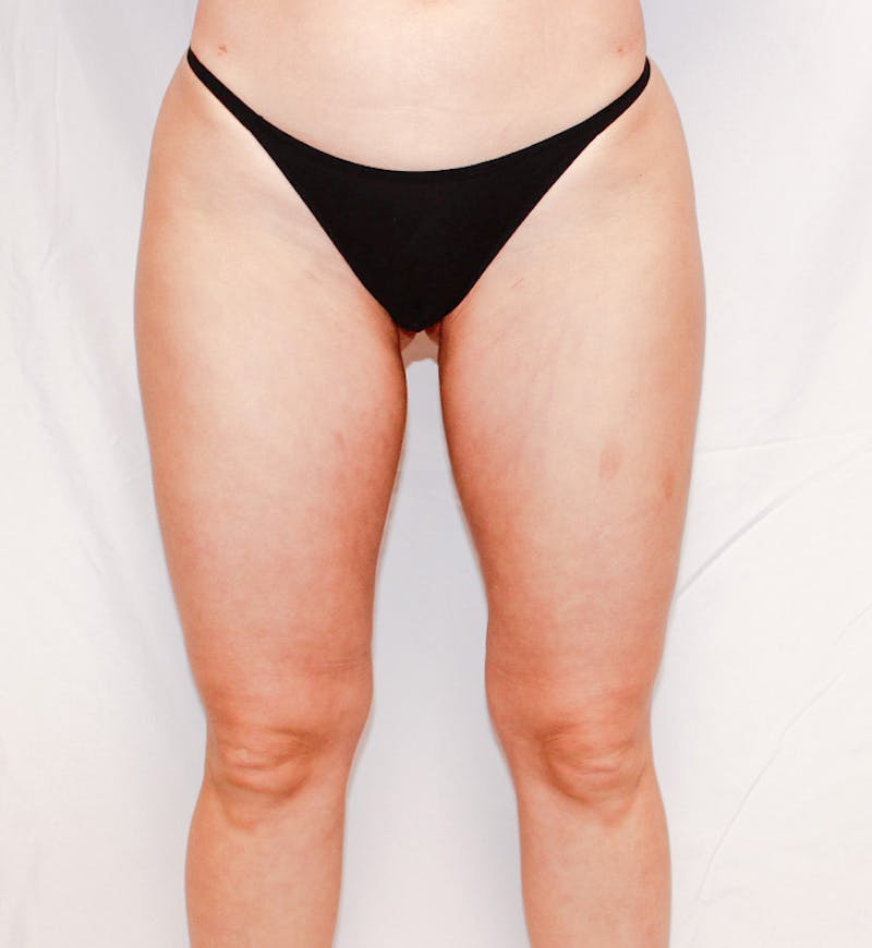 Liposuction Before & After Gallery - Patient 608050 - Image 14