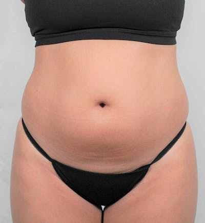 Liposuction Before & After Gallery - Patient 202727 - Image 1