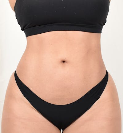 Liposuction Before & After Gallery - Patient 202727 - Image 2