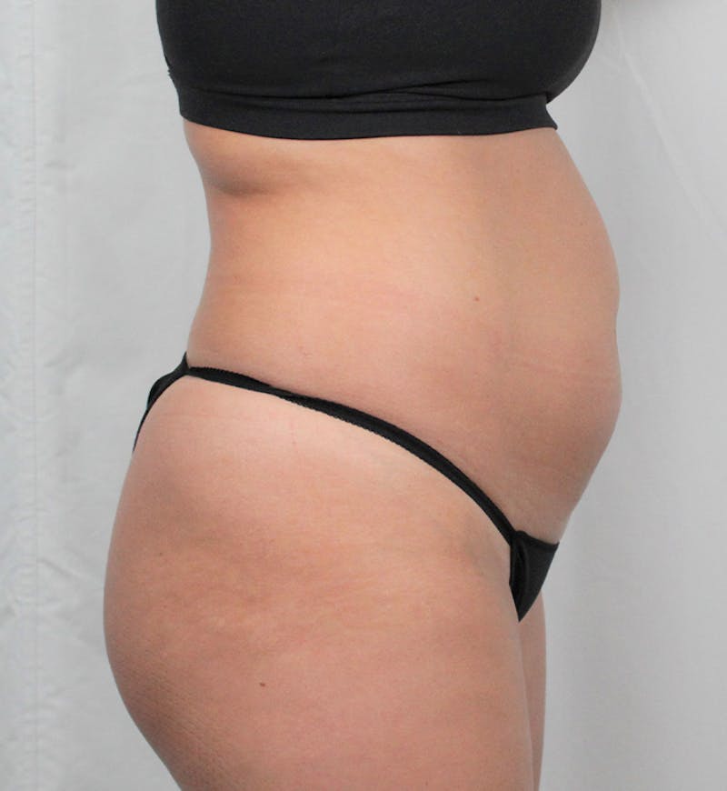Liposuction Before & After Gallery - Patient 202727 - Image 3