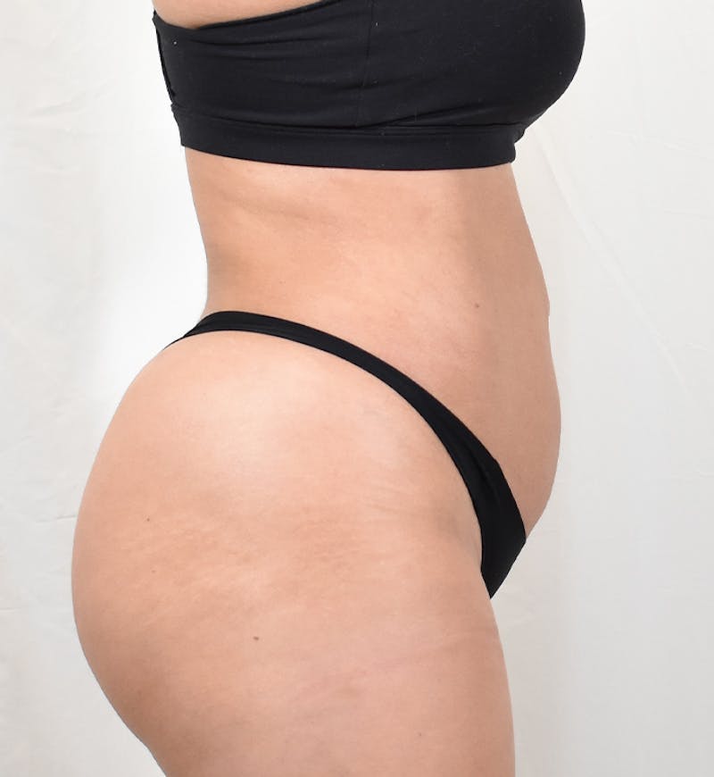 Liposuction Before & After Gallery - Patient 202727 - Image 4