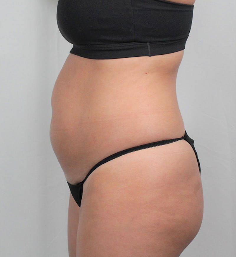 Liposuction Before & After Gallery - Patient 202727 - Image 5