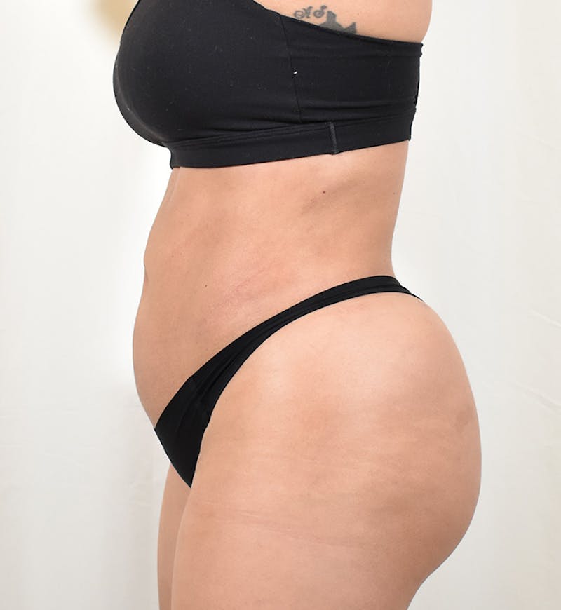 Liposuction Before & After Gallery - Patient 202727 - Image 6