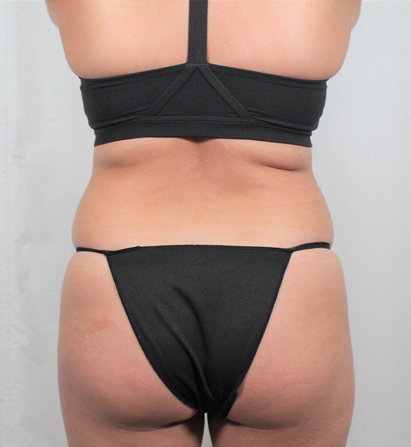 Liposuction Before & After Gallery - Patient 202727 - Image 7