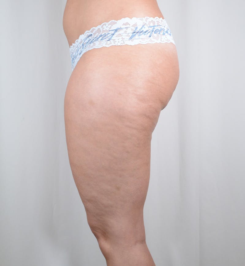 Liposuction Before & After Gallery - Patient 282724 - Image 13