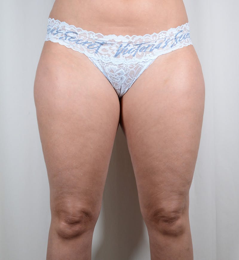 Liposuction Before & After Gallery - Patient 282724 - Image 9