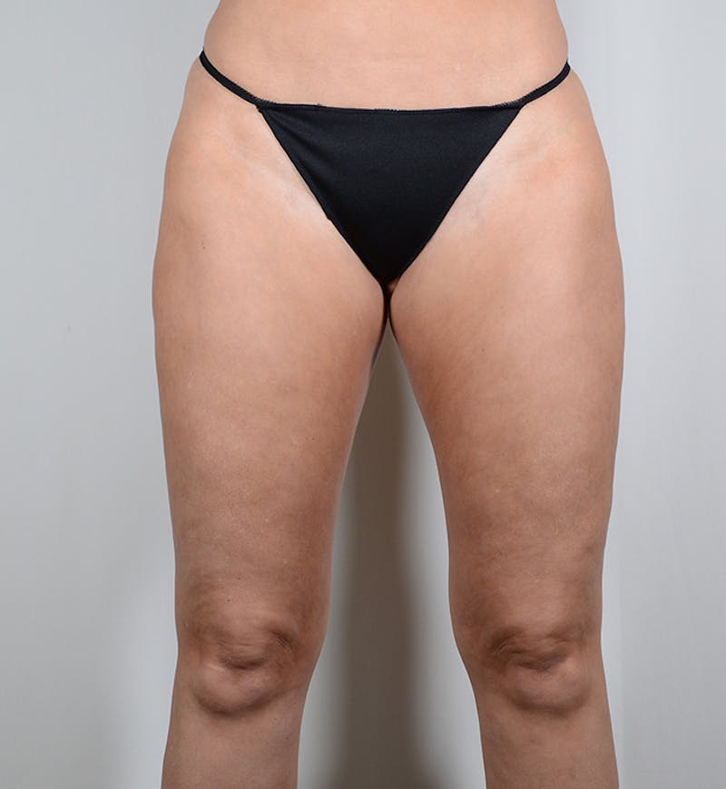 Liposuction Before & After Gallery - Patient 282724 - Image 10