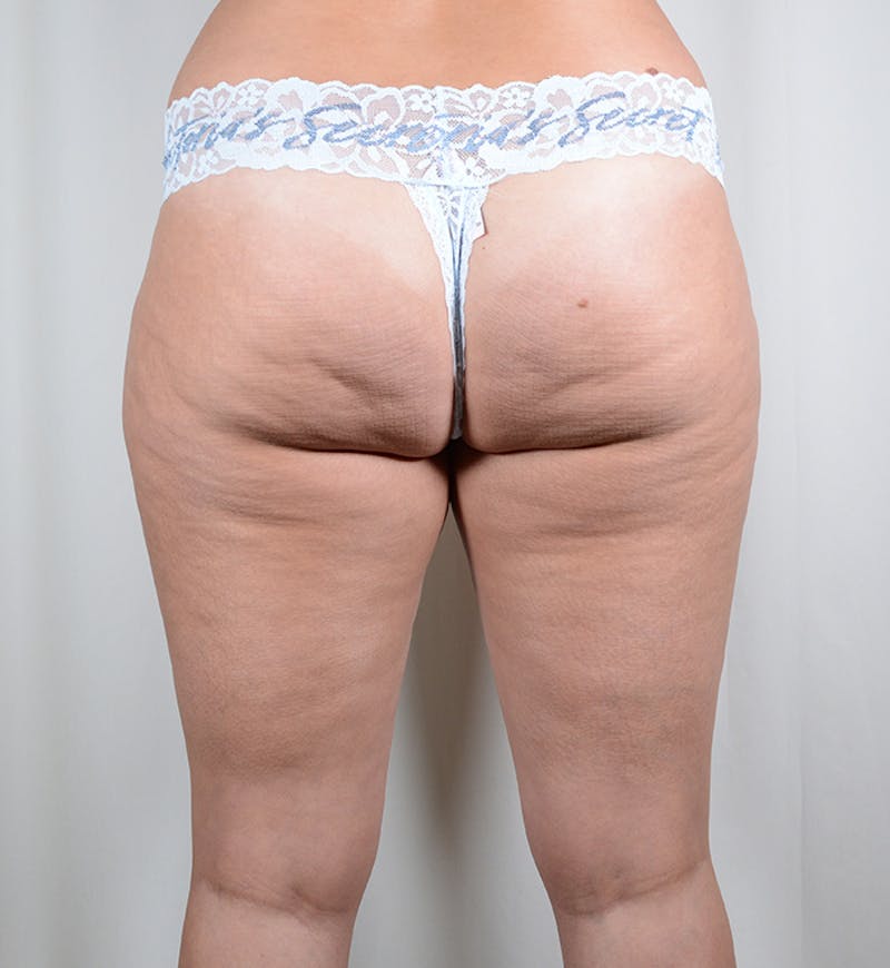 Liposuction Before & After Gallery - Patient 282724 - Image 15