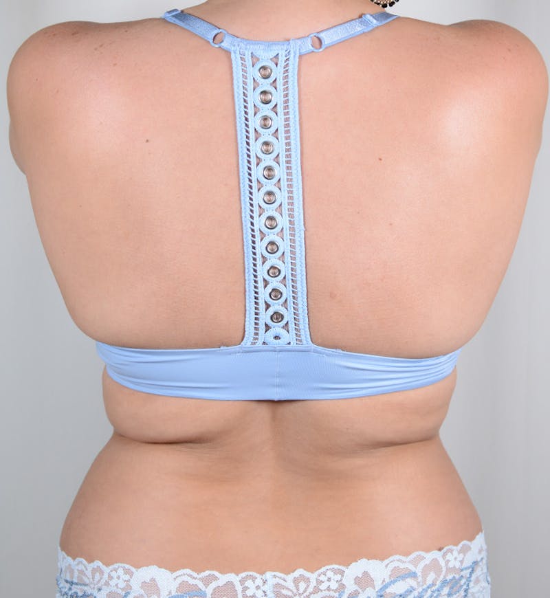Liposuction Before & After Gallery - Patient 282724 - Image 7