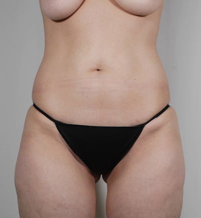 Liposuction Before & After Gallery - Patient 269254 - Image 1