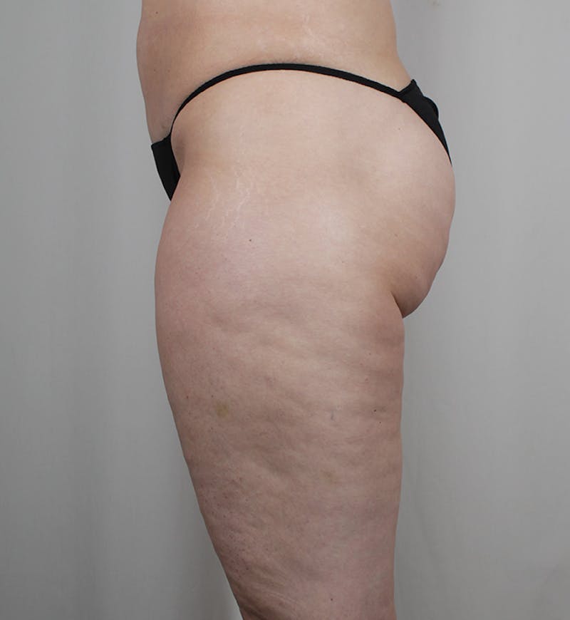 Liposuction Before & After Gallery - Patient 269254 - Image 5