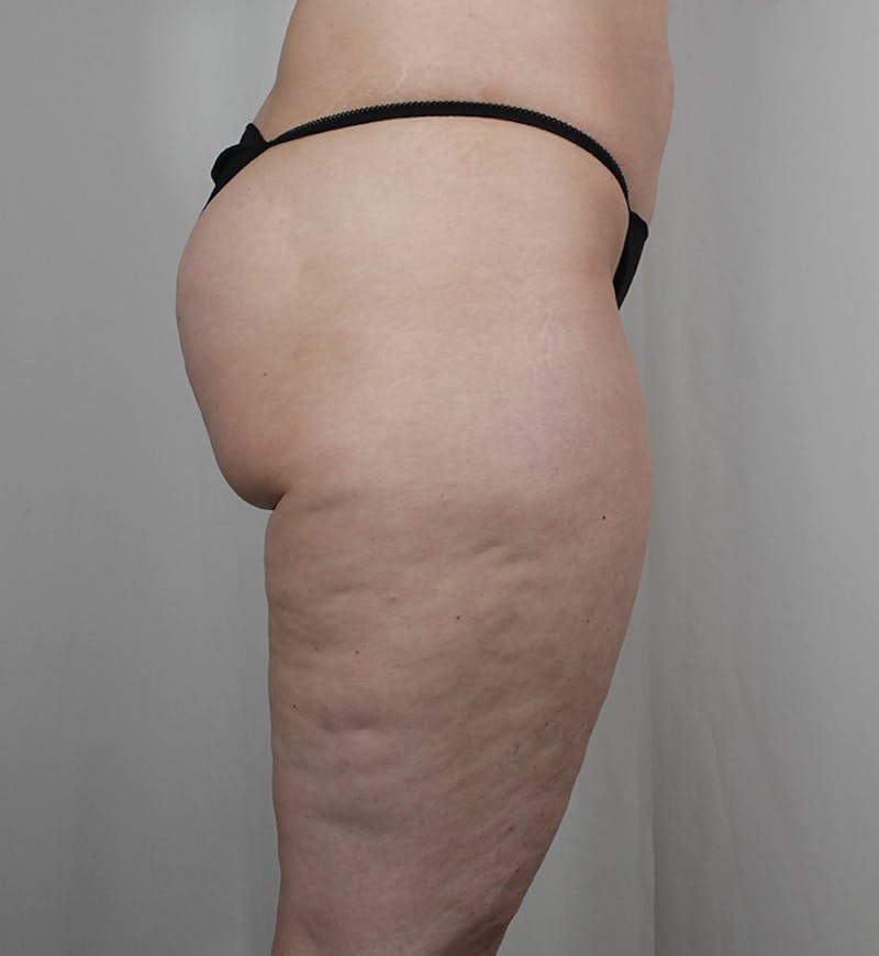 Liposuction Before & After Gallery - Patient 269254 - Image 3