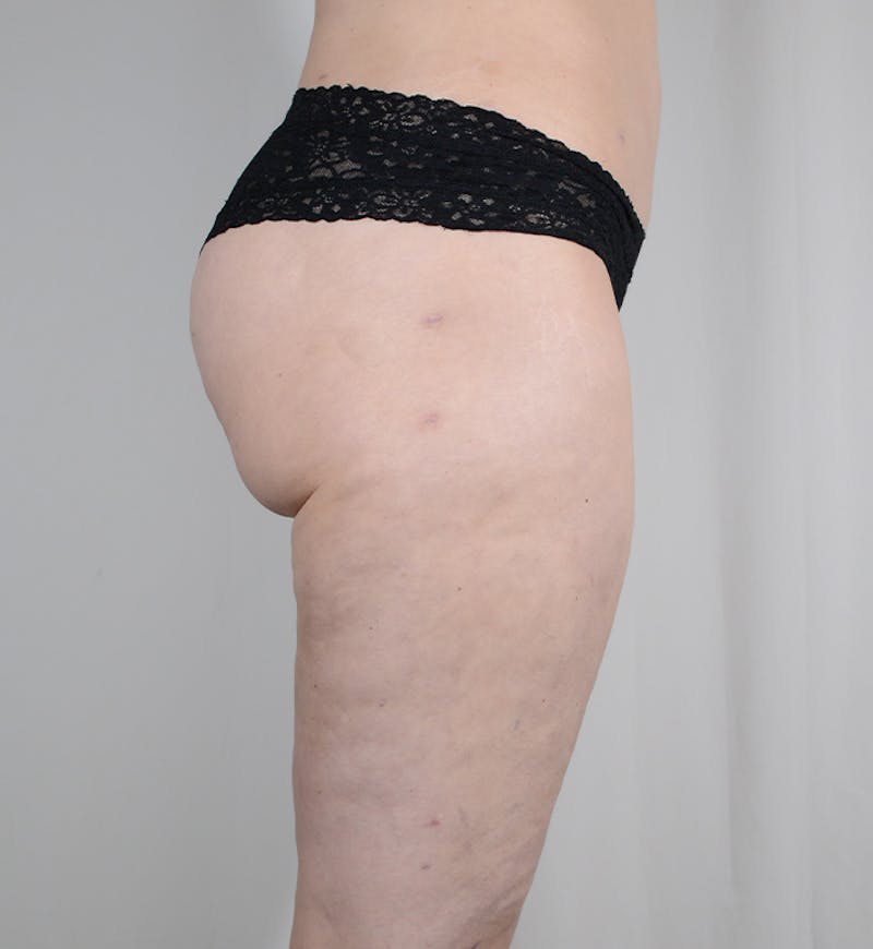 Liposuction Before & After Gallery - Patient 269254 - Image 4