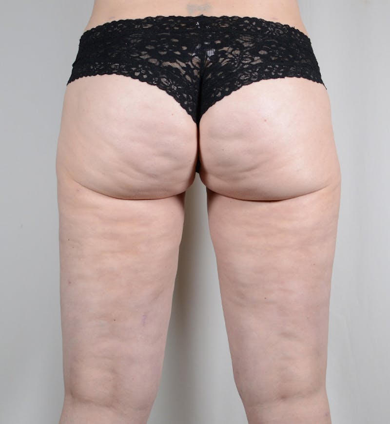 Liposuction Before & After Gallery - Patient 269254 - Image 8