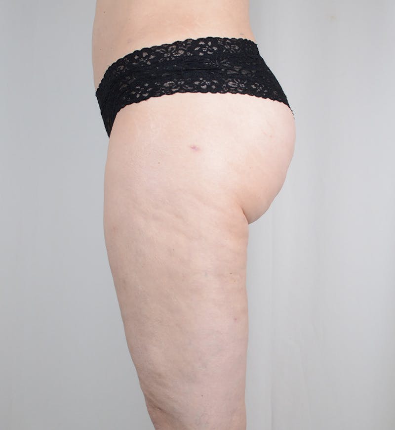 Liposuction Before & After Gallery - Patient 269254 - Image 6