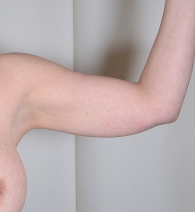 Liposuction Before & After Gallery - Patient 934046 - Image 2