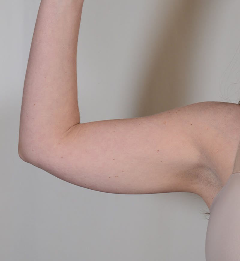 Liposuction Before & After Gallery - Patient 934046 - Image 3