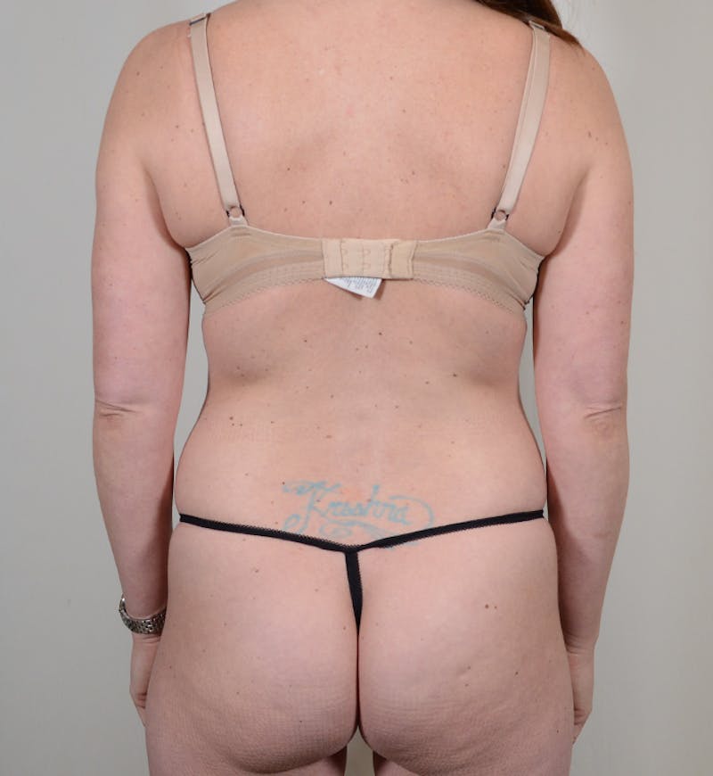 Liposuction Before & After Gallery - Patient 934046 - Image 9
