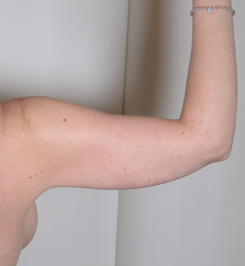 Liposuction Before & After Gallery - Patient 934046 - Image 8