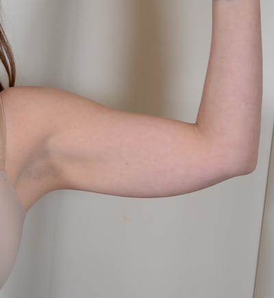 Liposuction Before & After Gallery - Patient 934046 - Image 1