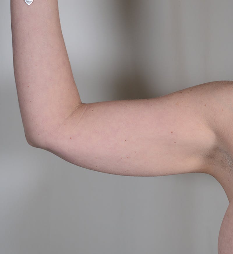 Liposuction Before & After Gallery - Patient 934046 - Image 4