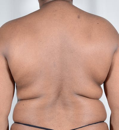 Liposuction Before & After Gallery - Patient 122015 - Image 1