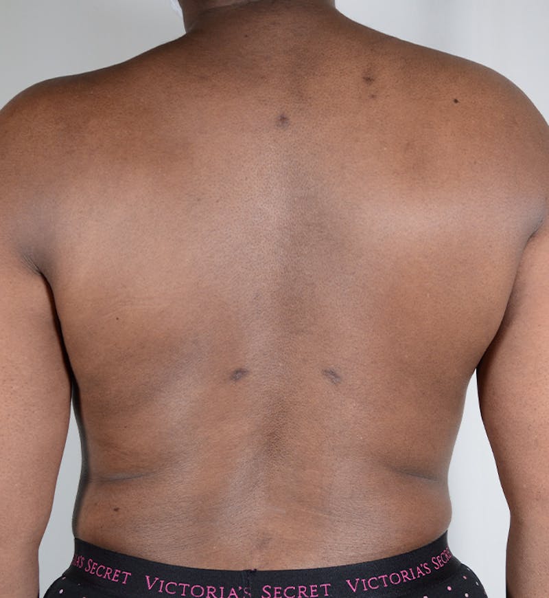 Liposuction Before & After Gallery - Patient 122015 - Image 4