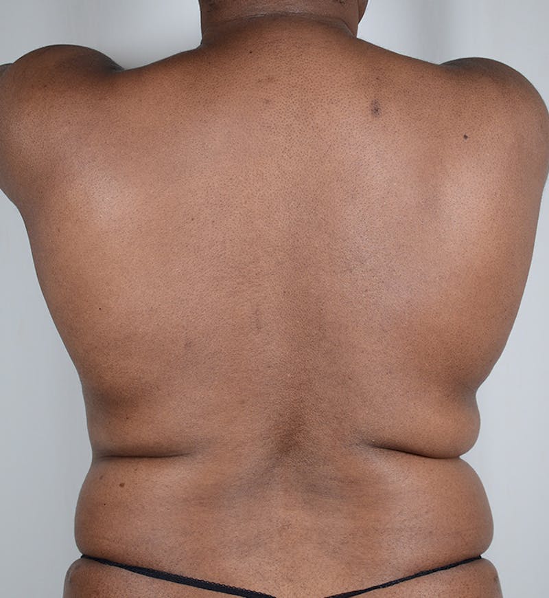 Liposuction Before & After Gallery - Patient 122015 - Image 3