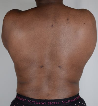 Liposuction Before & After Gallery - Patient 122015 - Image 2