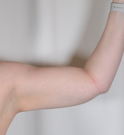 Liposuction Before & After Gallery - Patient 368536 - Image 2
