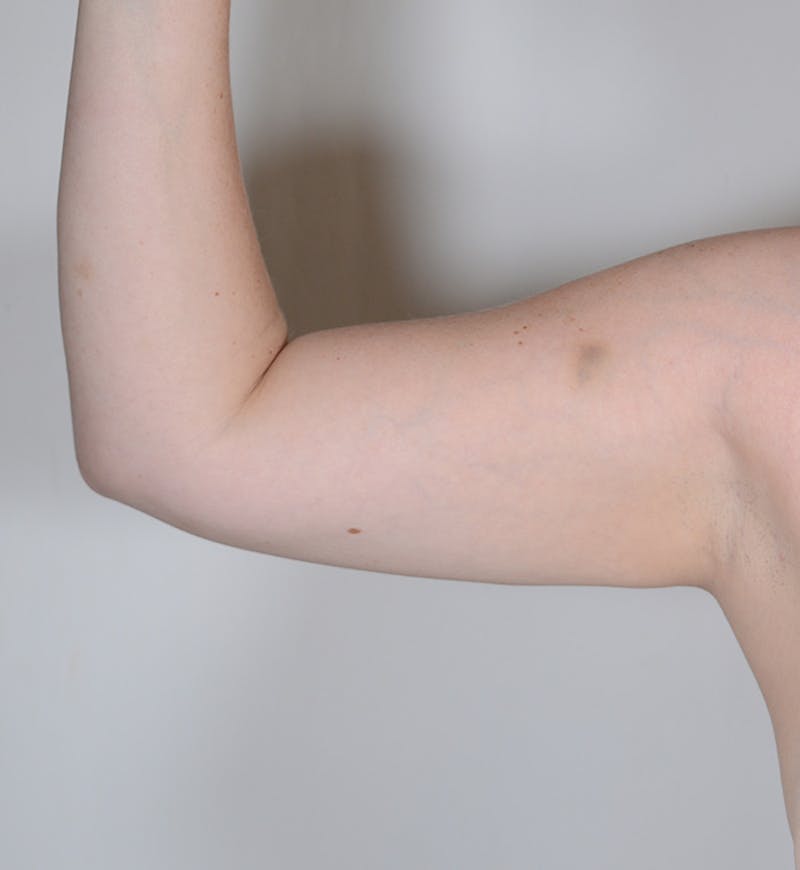 Liposuction Before & After Gallery - Patient 368536 - Image 3