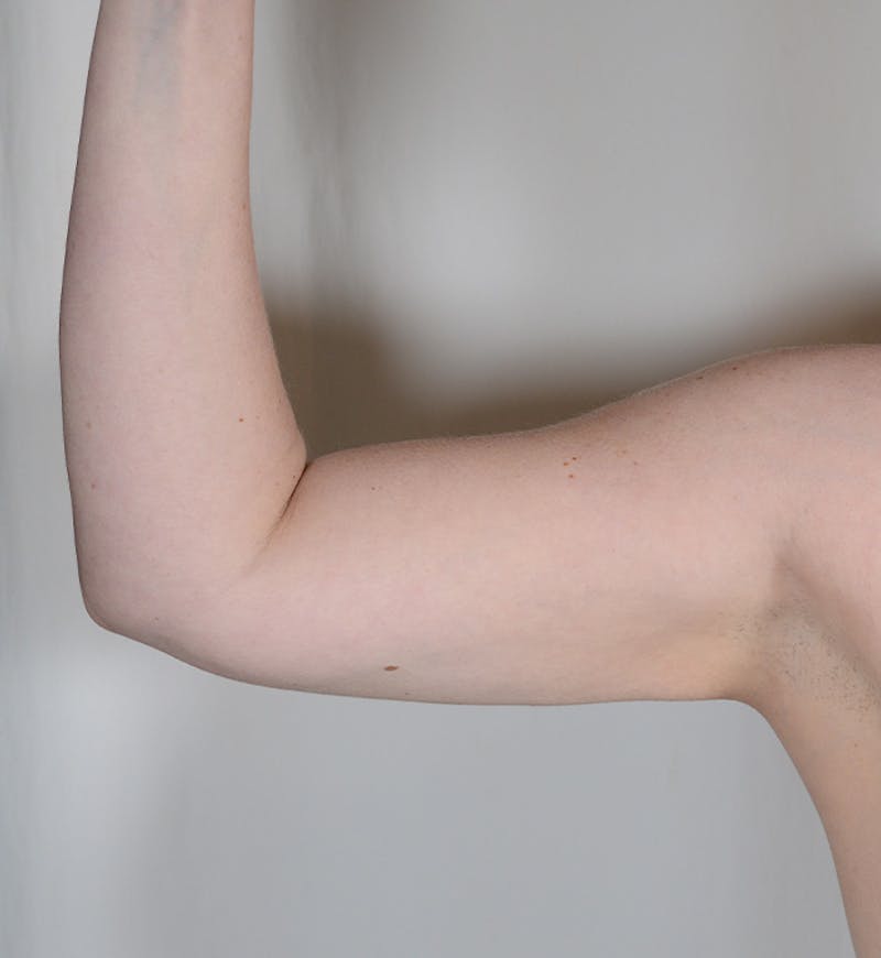 Liposuction Before & After Gallery - Patient 368536 - Image 4