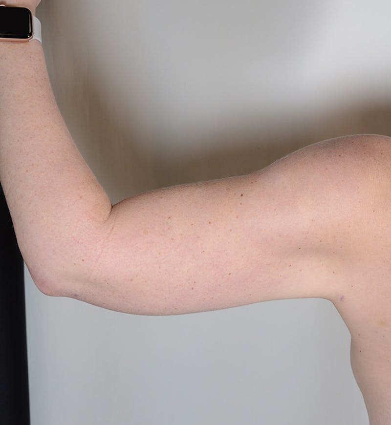 Liposuction Before & After Gallery - Patient 368536 - Image 6
