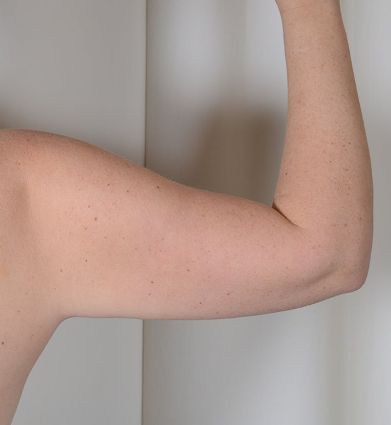 Liposuction Before & After Gallery - Patient 368536 - Image 7
