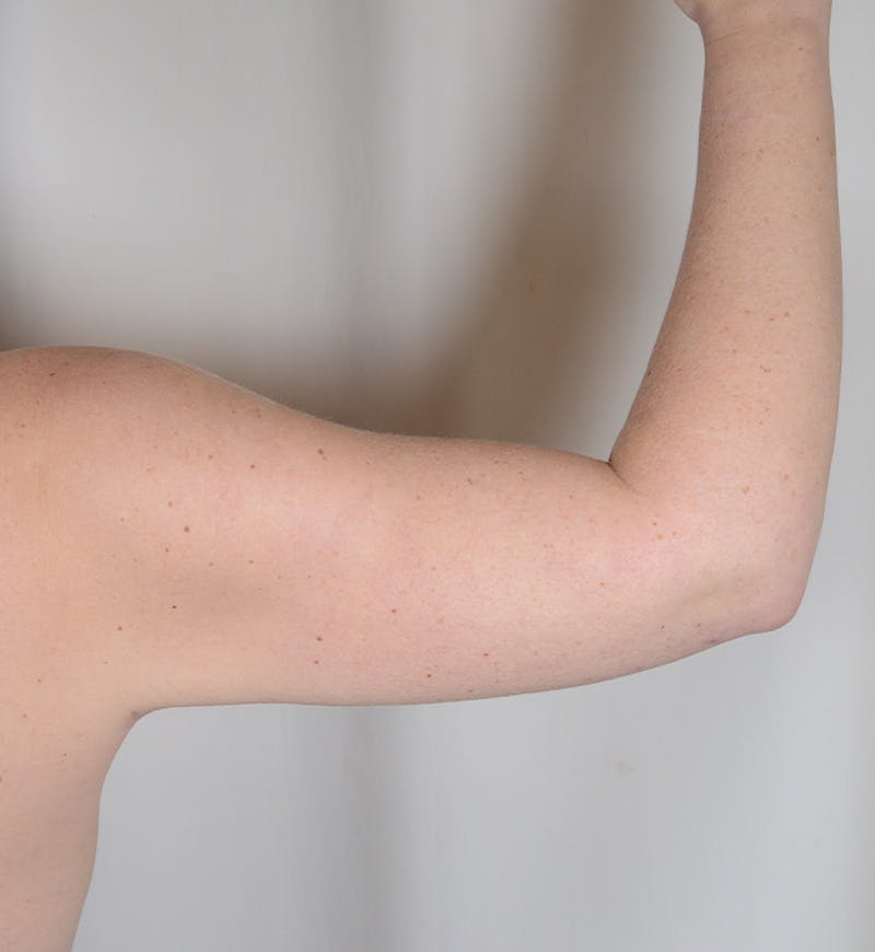 Liposuction Before & After Gallery - Patient 368536 - Image 8