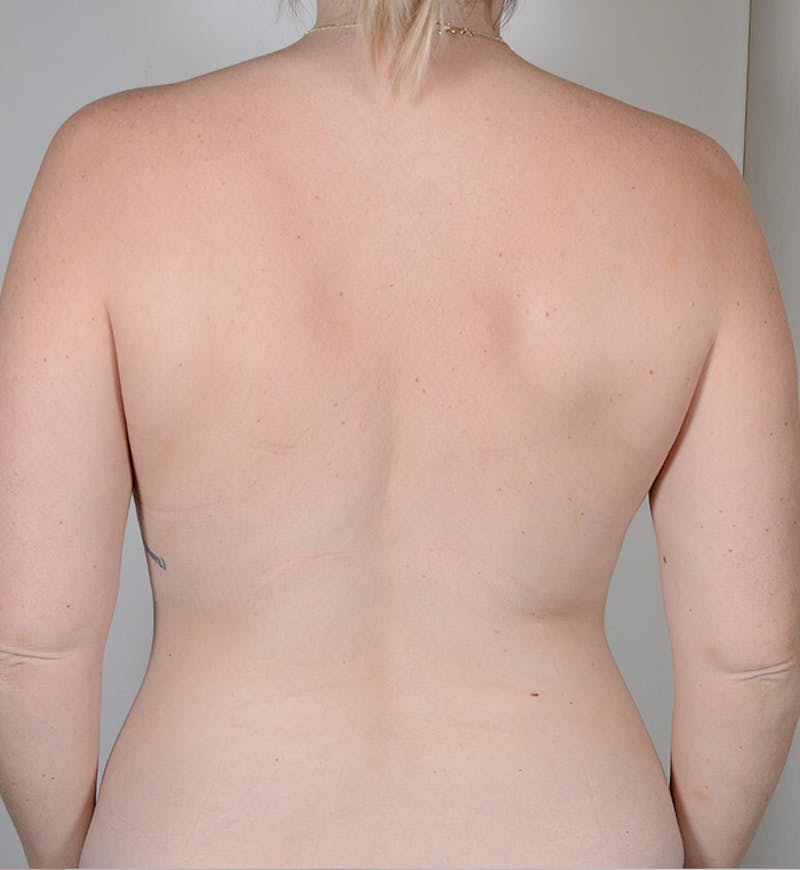 Liposuction Before & After Gallery - Patient 368536 - Image 9