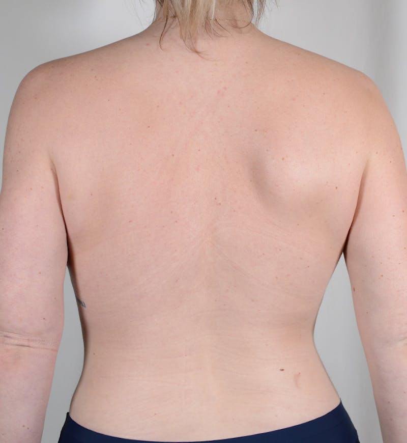 Liposuction Before & After Gallery - Patient 368536 - Image 10