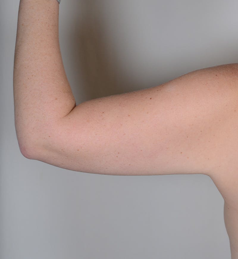 Liposuction Before & After Gallery - Patient 368536 - Image 5