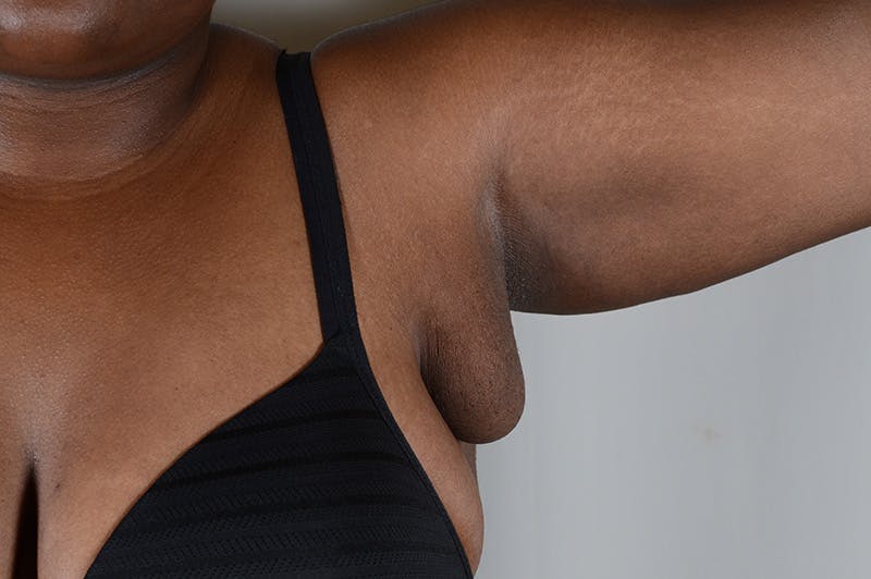 Axillary Breast Tissue Before & After Gallery - Patient 188969 - Image 7